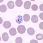 Sốt rét do ký sinh trùng khỉ Plasmodium knowlesi tại Việt Nam tổng hợp và cập nhật y văn thế giới
