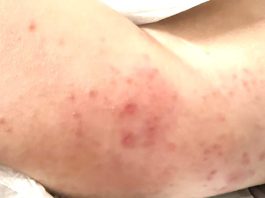 Trẻ suy dinh dưỡng, mẩn ngứa nên làm xét nghiệm ký sinh trùng gì?