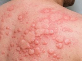 Cần làm những xét nghiệm nào để biết sẩn ngứa mày đay có phải do ký sinh trùng hay không?