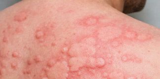 Cần làm những xét nghiệm nào để biết sẩn ngứa mày đay có phải do ký sinh trùng hay không?