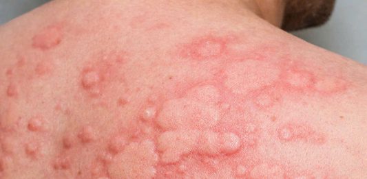 Cần làm những xét nghiệm nào để biết sẩn ngứa mày đay có phải do ký sinh trùng hay không?