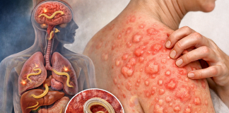 Sau điều trị bao lâu thì khỏi bệnh do giun đũa chó mèo?