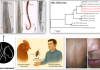 Ca bệnh hiếm gặp: bệnh ấu trùng di chuyển ở người nguyên nhân bởi giun tròn Oxyspirura mansoni